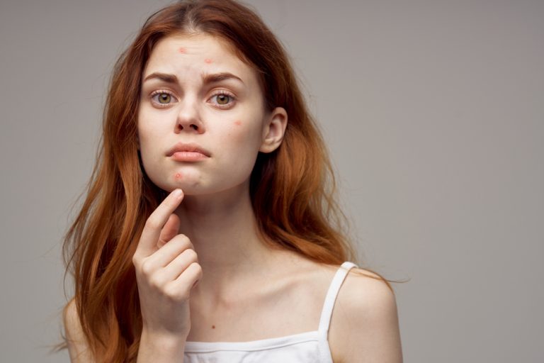 The Benefits of Using Vitamin C Serum for Acne-Prone Skin