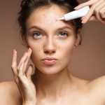Vitamin C serum for acne-prone skin