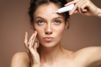 Vitamin C serum for acne-prone skin