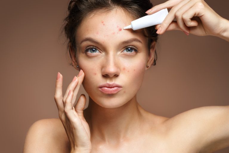 Vitamin C serum for acne-prone skin