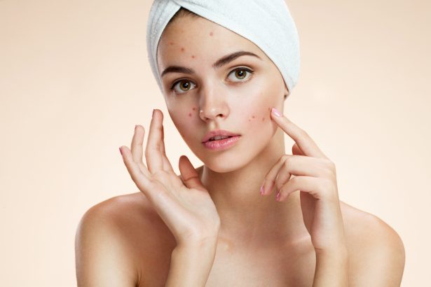 Effective oily skin treatments for acne-prone skin Strategies for Clear, Healthy Skin