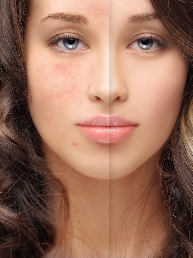 Benefits of Niacinamide Serums for Acne-Prone Skin