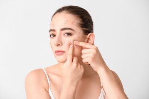 How to Get Rid of Acne Scars?