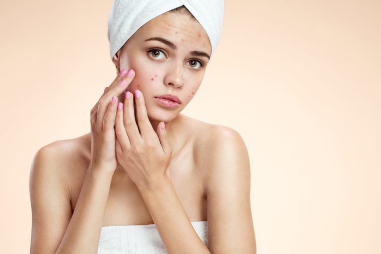 How to Get Rid of Acne Scars?