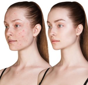 How to Get Rid of Acne Scars?