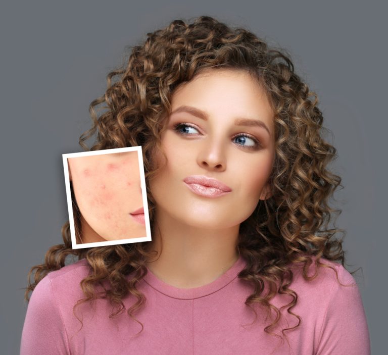 How to Treat Hyperpigmentation: A Comprehensive Guide